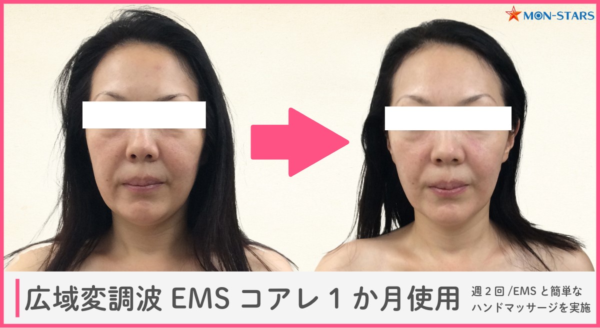 顔用EMSの使用結果