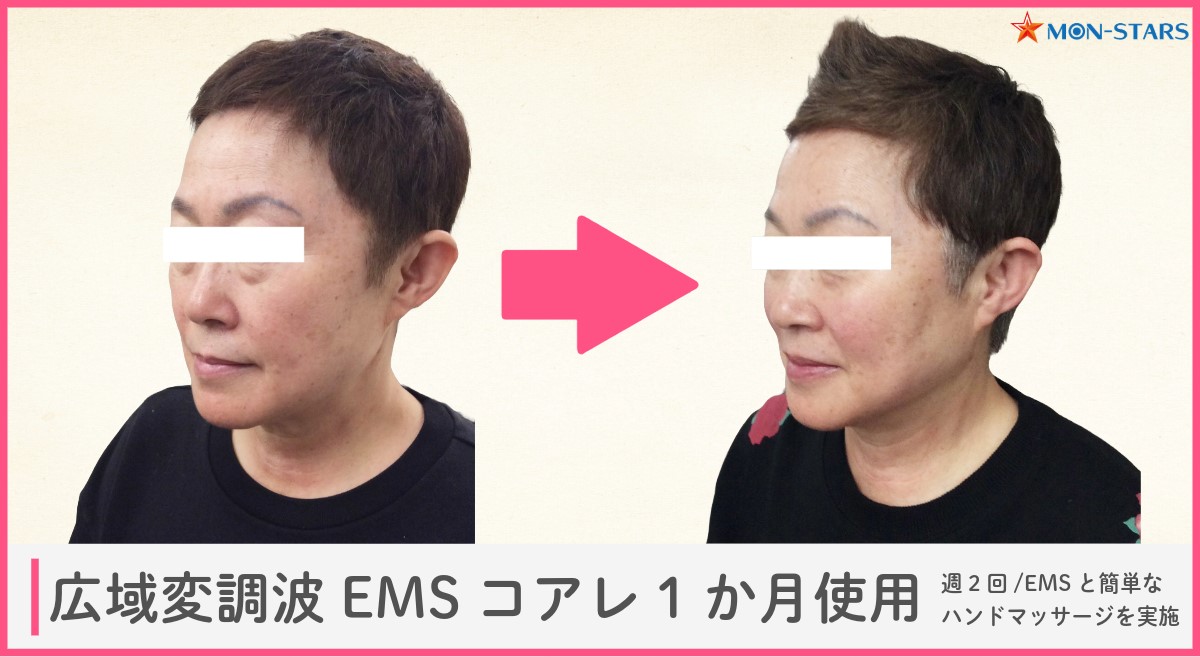 顔用EMSの使用結果